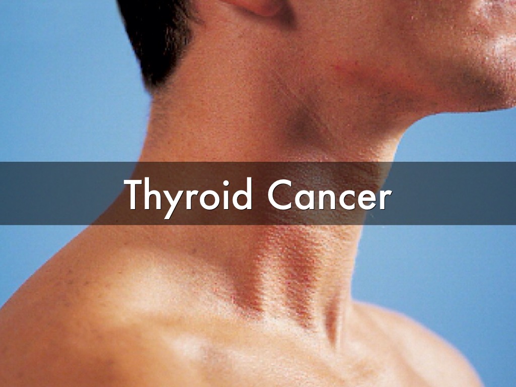 early stage cancer lymph nodes in neck